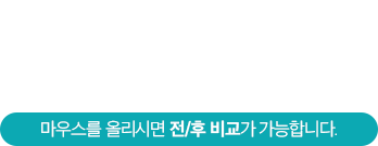 증상별 치아교정 사례